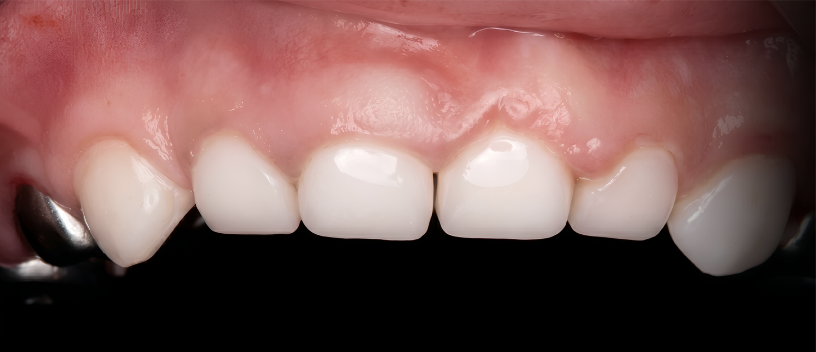 6 Anteriors — After