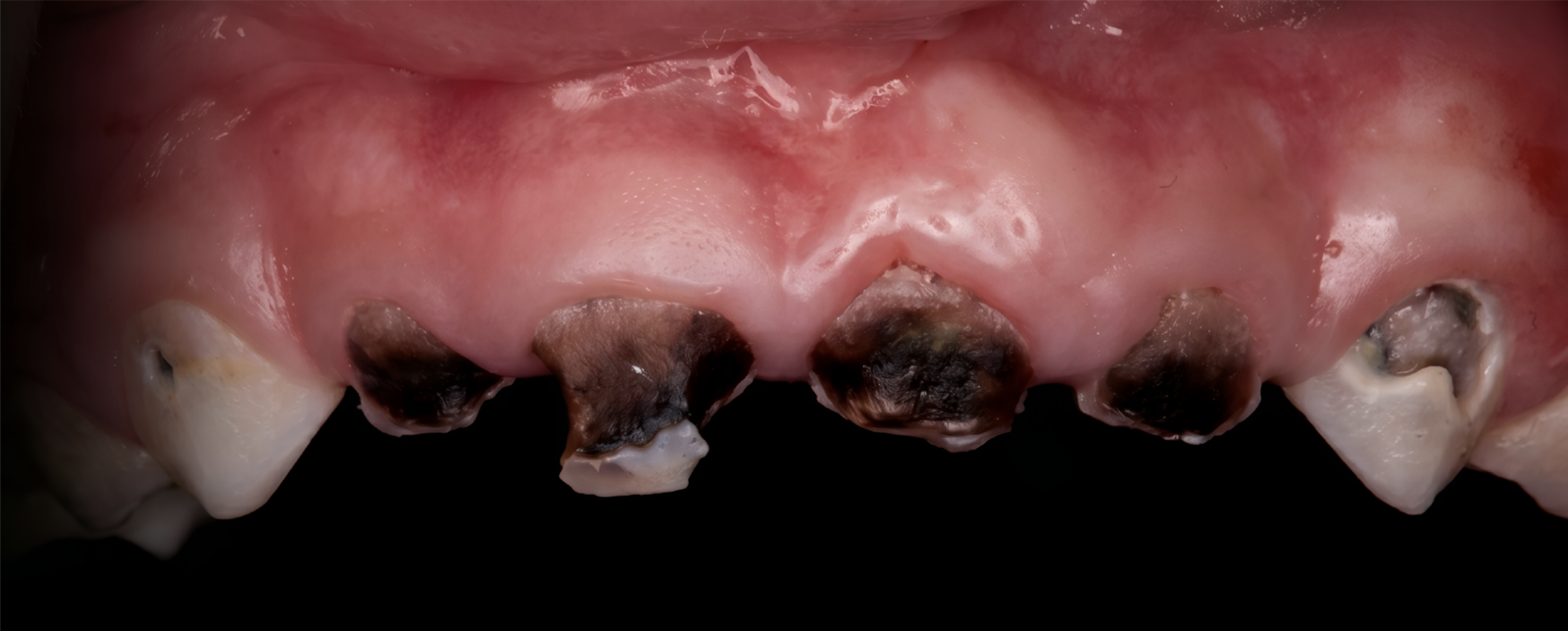 6 Anteriors — Before